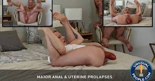 Cervix prolapse porn gifs pornhub jpg x Uterine prolapse