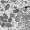 「サル痘」11か国で約80人の患者確認 WHOが警戒呼びかけ