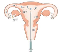 子宮口精子注射画像|相模ゴム工業 セルフシリンジ法 タイミングエイド キット （3回分） 妊活 妊娠 サポート 安心 安全 サガミ（送料無料） :  健康fan日興メディカル - 通販 - Yahoo!ショッピング