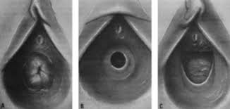  child labia hymen|Normal Examination Findings and Variants | SpringerLink