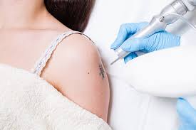 remove tattoo stock|