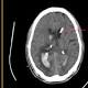 New therapy could double chances of recovery from bleeding stoke for some patients 