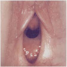 hymen child|Understanding Medical Findings in Child Sexual Abuse: An Update For 2018 -  Joyce A. Adams, 2018