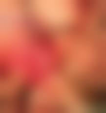 Отрезание пениса|Утолщение диаметра полового члена с помощью липофилинга и обрезание  одномоментно с фото-результатами сразу после