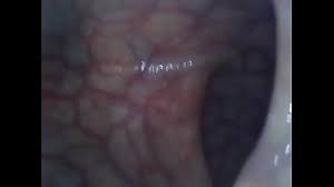 Endoscope anal endoscopy deep inside my… jpg x Endoscope anal
