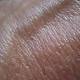 'Sunscreen Gene' May Be the Key in Preventing and Treating Skin Cancer 