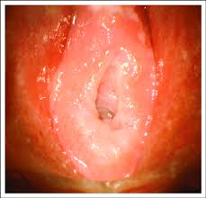 hymen child|The prepubertal hymen