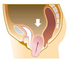 子宮脱|子宮脱と直腸脱の合併例