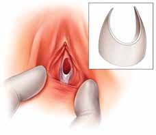 hymen child|a Baby girl presented with an imperforate hymen. She had a single left... |  Download Scientific Diagram