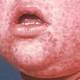 Melbourne measles outbreak spread: another confirmed case in Brunswick 