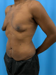 tiny puff nipples|I just started to workout and my puffy nipples slash gyno really makes me  feel bad idk what i should do : r/gynecomastia