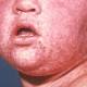 'Surge' in number of measles cases in Australia for 2014 prompts immunisation ... 