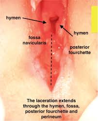 child hymen |Hymenal Characteristics in Girls with and without a History of Sexual Abuse