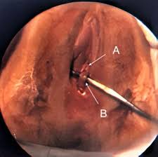 hymen child|Female Genitalia Terminology – Texas Evidence Collection Protocol