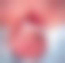 Отрезание пениса|Глансэктомия при раке полового члена с реконструкцией головки уретральным  лоскутом и последующей лигаментотомией | Экспериментальная и клиническая  урология