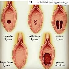 Hymen vagina|Hymen - an overview | ScienceDirect Topics