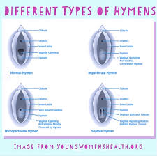 Hymen vagina|11. Hymenoplasty | Plastic Surgery Key