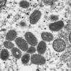 サル痘、国内で初の感染確認 東京都の30代男性、渡航先の欧州で ...