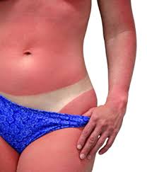 Bad Sunburn