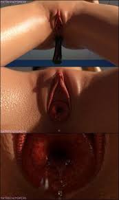 Vaginal prolapse jpg x Vaginal prolapse