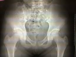 女児症例|突発性発疹（症例写真）（２ヶ月の女児）の説明スライド - 医療のイラスト・写真・動画、素材販売サイトのメディック(medick)