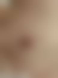 針乳首|乳頭縮小手術キャプチャ（写真）解説 ： 施術の流れを写真で解説：美容外科 高須クリニック