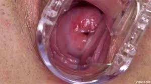 Vaginal speculum jpg x Vaginal speculum
