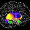 Huntington's disease