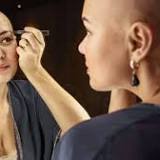 FDA Approves First Pill to Treat Severe Alopecia Areata