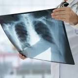 Sure Signs You Have Lung Cancer, Says Physician