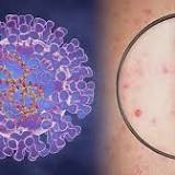 Mayo Clinic Laboratories to begin monkeypox testing in CDC partnership