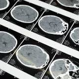 Decades of Alzheimer's Research Allegedly Based on Fabricated Data