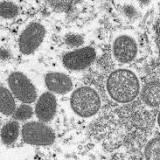California Man Infected With COVID-19 and Monkeypox at the Same Time