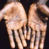 Monkeypox: WA has first brush with disease after case infectious in Perth for four days