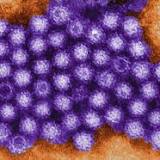 Crohn's disease risk may be linked to norovirus infection, study shows