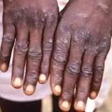 Monkeypox: How to protect yourself against the virus