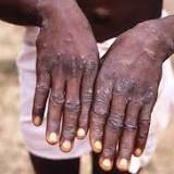 WHO reports 14000 monkey pox cases globally, 5 deaths