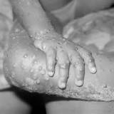 WHO calls monkeypox outbreak 'unusual, concerning'; know what qualifies as a public health emergency