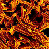 Tuberculosis cases rise in Washington, leading to the state's largest outbreak in 20 years