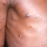 Two confirmed monkeypox cases in Appleton
