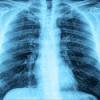White lung syndrome pneumonia